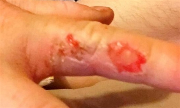 索尼手機(jī)也爆炸了:機(jī)主被燒慘